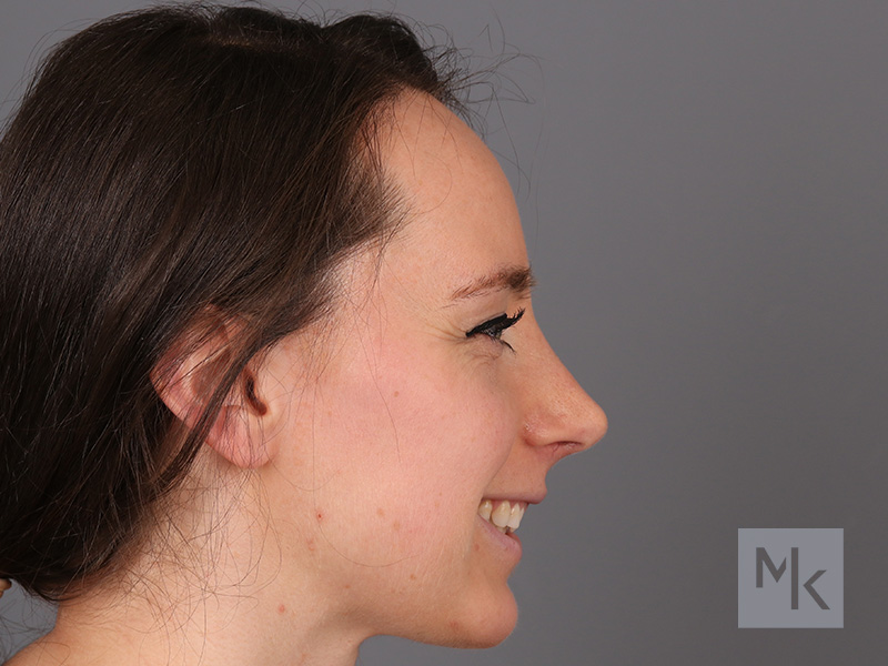 Rhinoplasty Before and After | Dr. Michael Kim