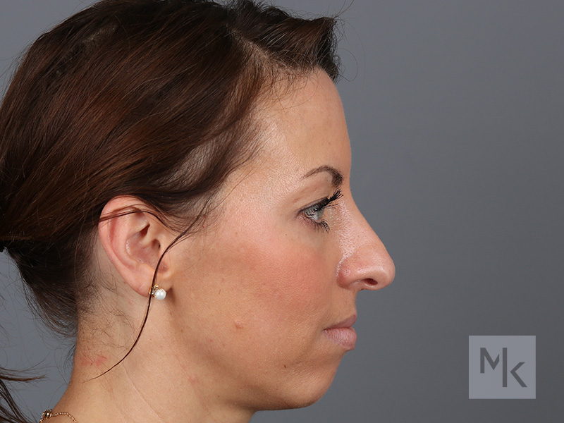 Rhinoplasty Before and After | Dr. Michael Kim