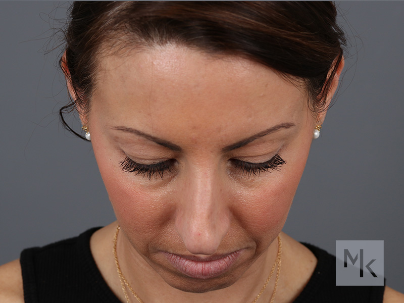 Rhinoplasty Before and After | Dr. Michael Kim