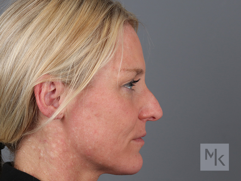 Rhinoplasty Before and After | Dr. Michael Kim