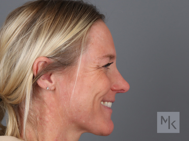 Rhinoplasty Before and After | Dr. Michael Kim