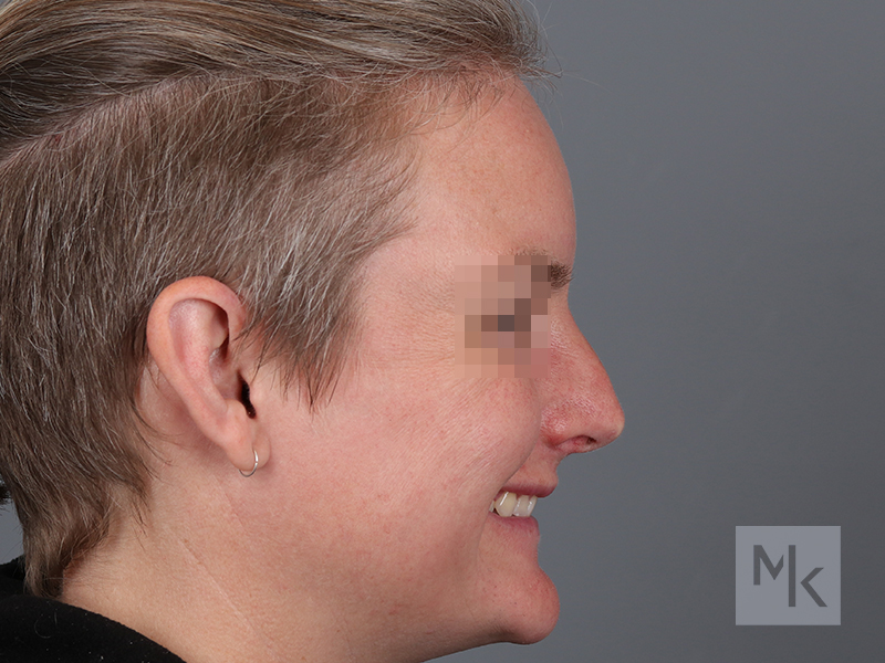 Rhinoplasty Before and After | Dr. Michael Kim