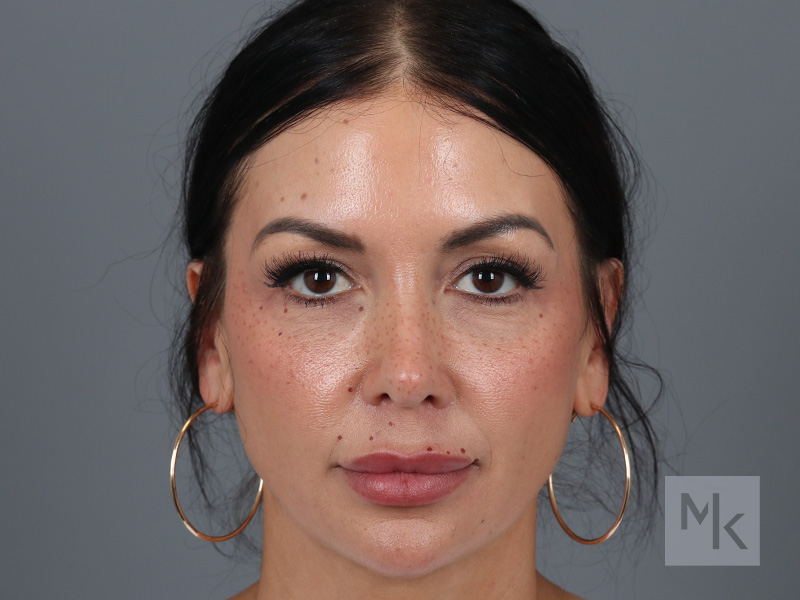 Rhinoplasty Before and After | Dr. Michael Kim