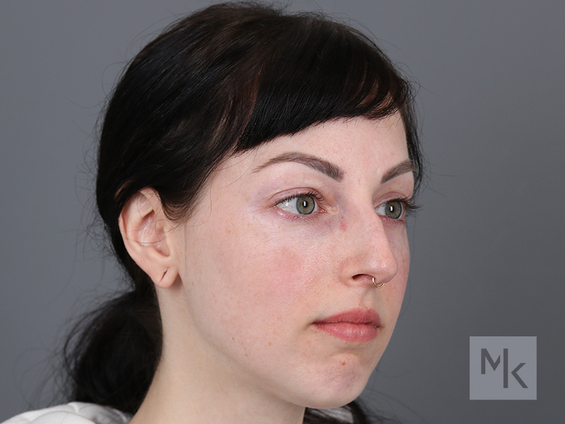 Rhinoplasty Before and After | Dr. Michael Kim