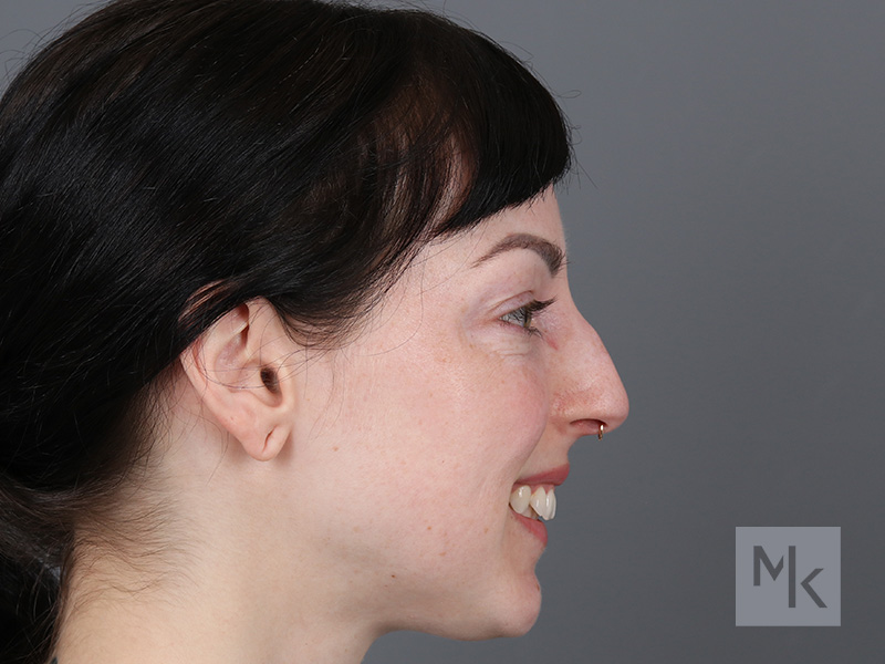 Rhinoplasty Before and After | Dr. Michael Kim