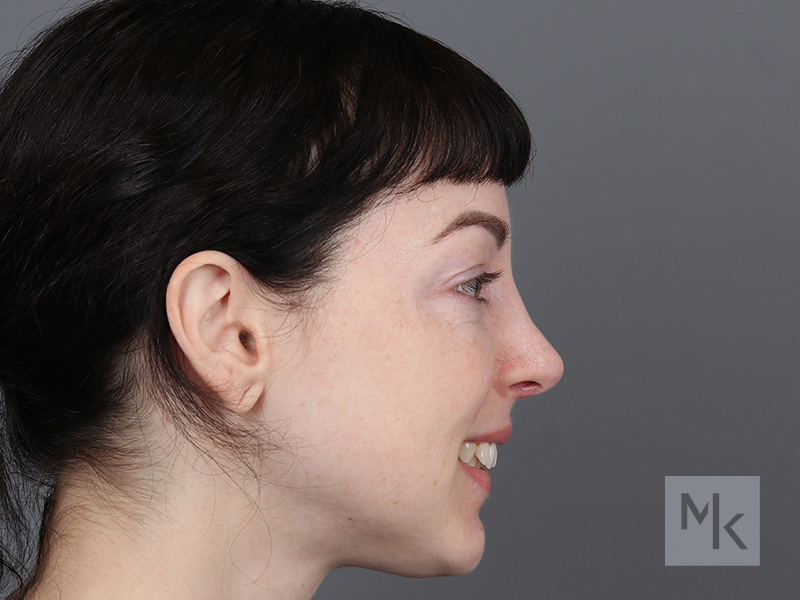 Rhinoplasty Before and After | Dr. Michael Kim