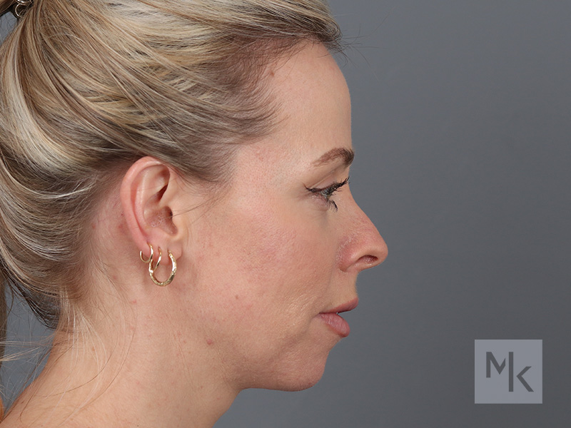 Rhinoplasty Before and After | Dr. Michael Kim