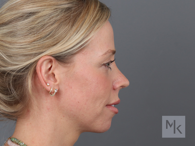 Rhinoplasty Before and After | Dr. Michael Kim