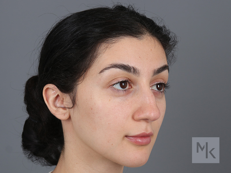 Rhinoplasty Before and After | Dr. Michael Kim