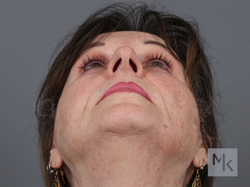 Rhinoplasty Before and After | Dr. Michael Kim