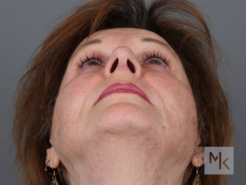 Rhinoplasty Before and After | Dr. Michael Kim