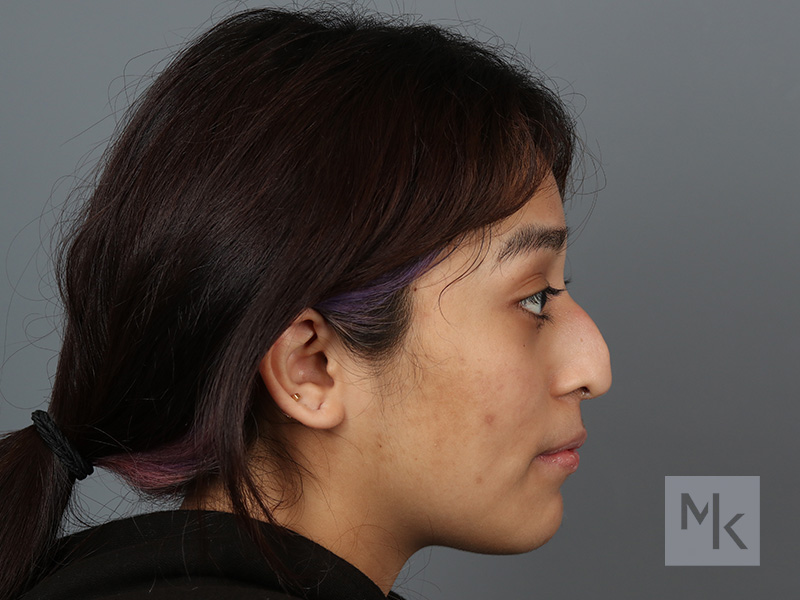 Rhinoplasty Before and After | Dr. Michael Kim