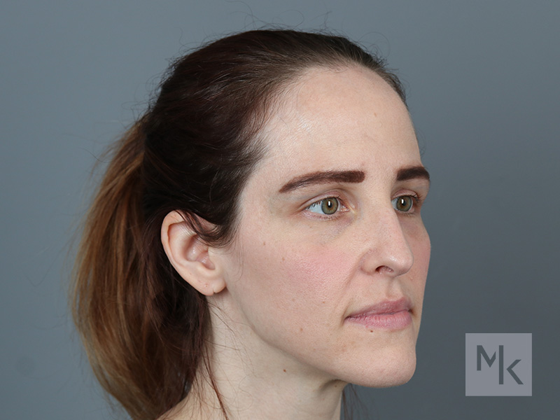 Rhinoplasty Before and After | Dr. Michael Kim