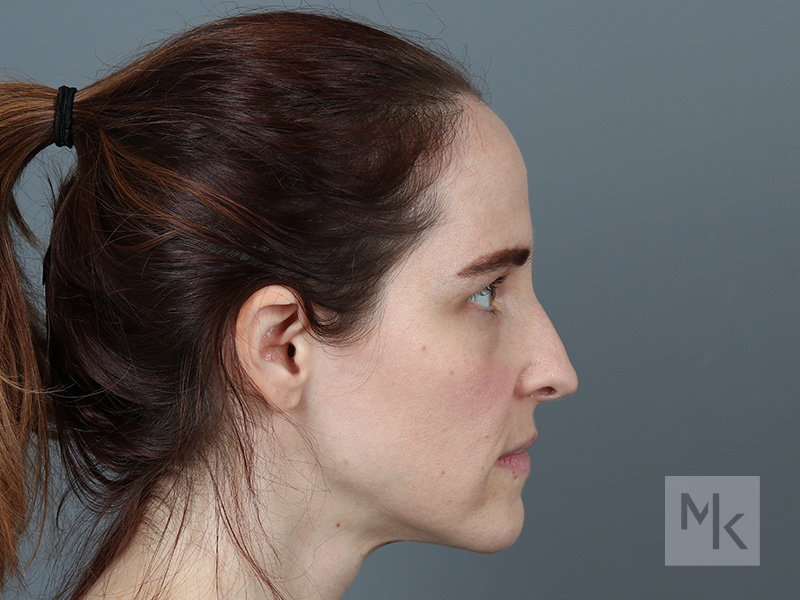 Rhinoplasty Before and After | Dr. Michael Kim