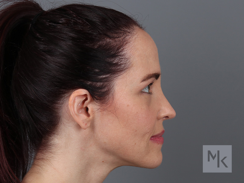 Rhinoplasty Before and After | Dr. Michael Kim