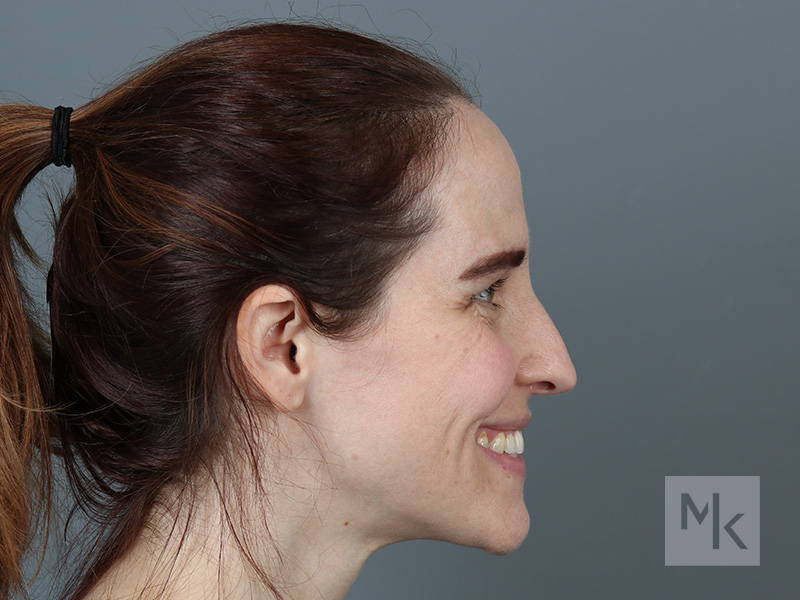 Rhinoplasty Before and After | Dr. Michael Kim