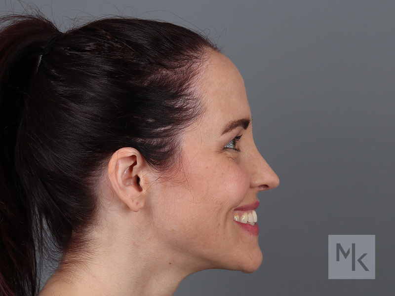 Rhinoplasty Before and After | Dr. Michael Kim