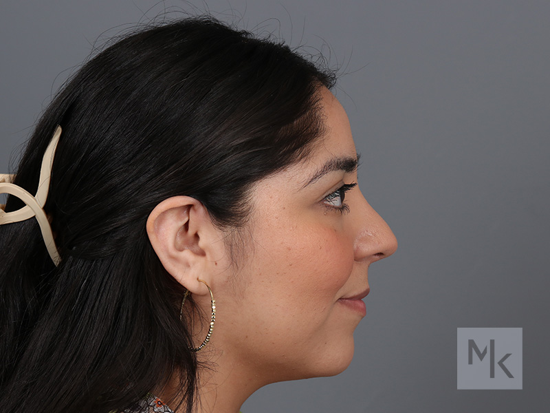 Rhinoplasty Before and After | Dr. Michael Kim