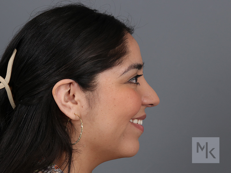 Rhinoplasty Before and After | Dr. Michael Kim