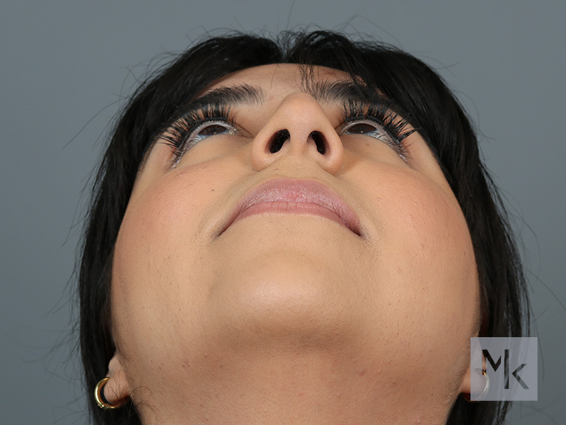 Rhinoplasty Before and After | Dr. Michael Kim