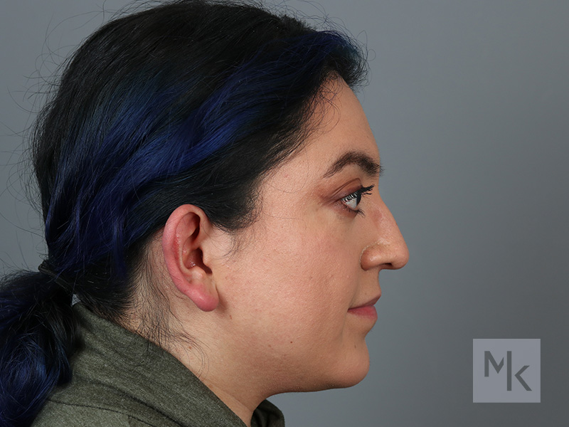 Rhinoplasty Before and After | Dr. Michael Kim