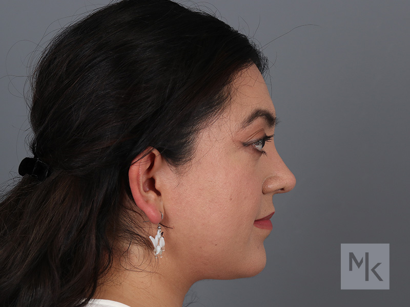 Rhinoplasty Before and After | Dr. Michael Kim