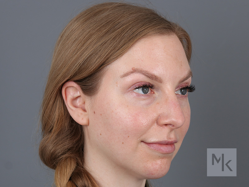 Rhinoplasty Before and After | Dr. Michael Kim