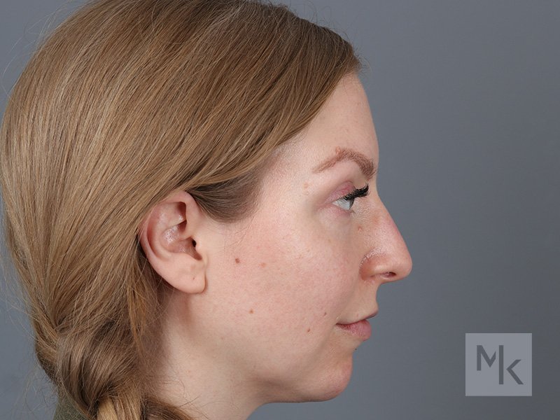 Rhinoplasty Before and After | Dr. Michael Kim