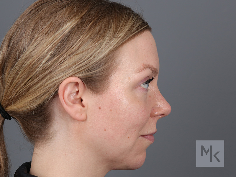 Rhinoplasty Before and After | Dr. Michael Kim