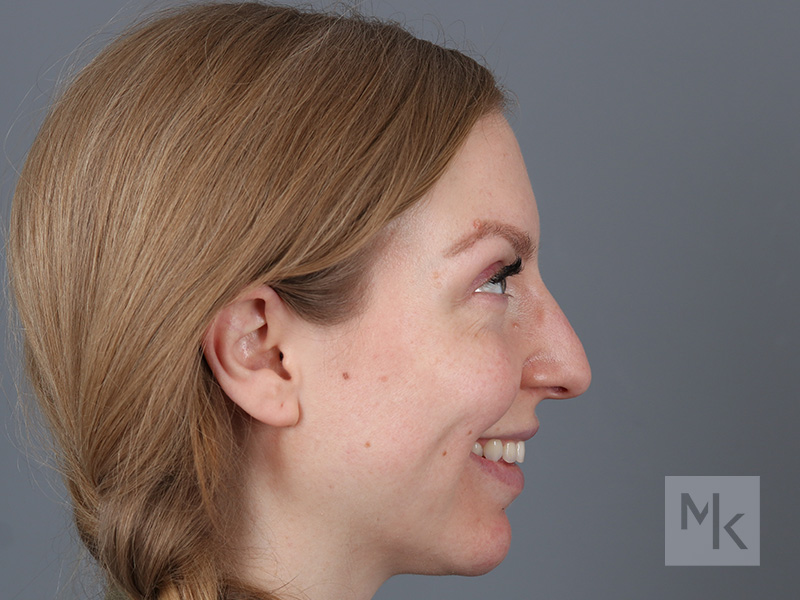 Rhinoplasty Before and After | Dr. Michael Kim