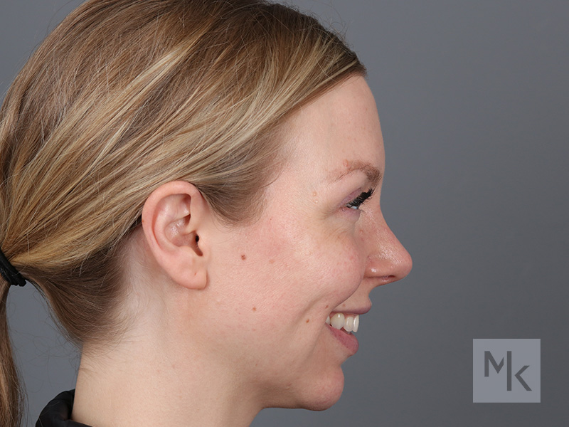 Rhinoplasty Before and After | Dr. Michael Kim