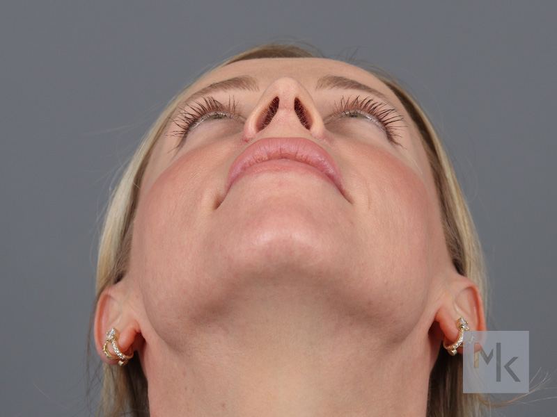 Rhinoplasty Before and After | Dr. Michael Kim