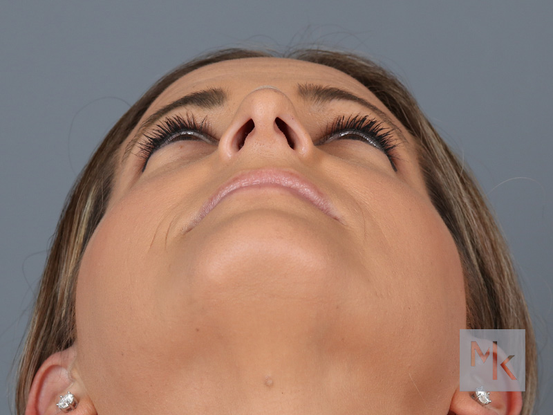 Rhinoplasty Before and After | Dr. Michael Kim