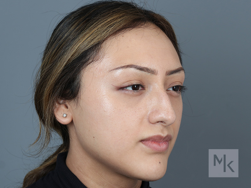 Rhinoplasty Before and After | Dr. Michael Kim