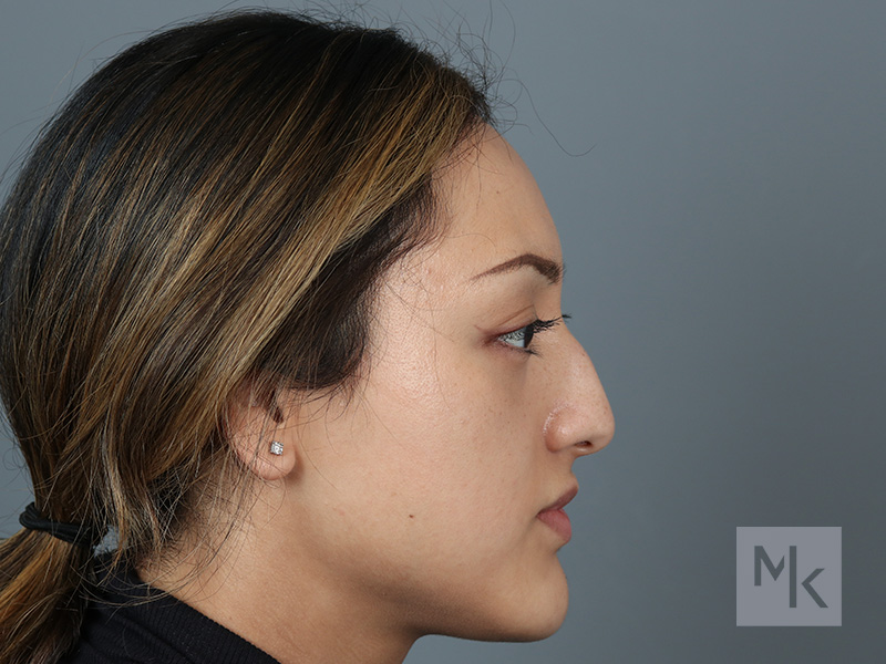 Rhinoplasty Before and After | Dr. Michael Kim