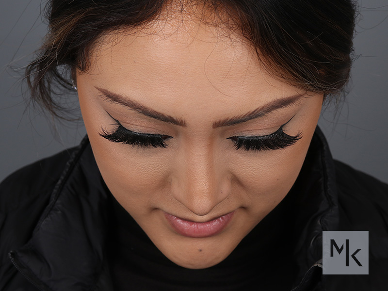 Rhinoplasty Before and After | Dr. Michael Kim