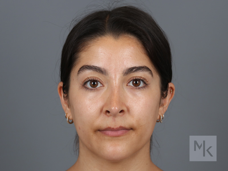 Rhinoplasty Before and After | Dr. Michael Kim