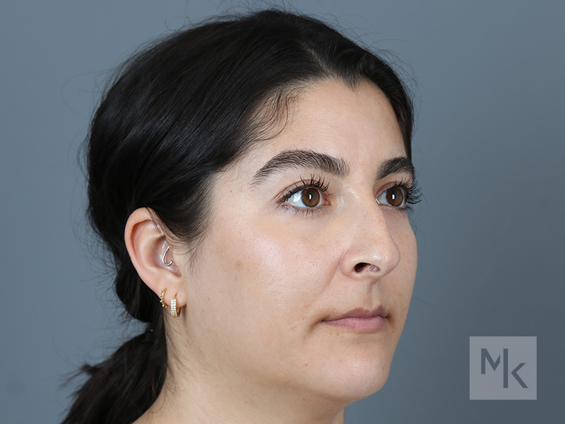 Rhinoplasty Before and After | Dr. Michael Kim