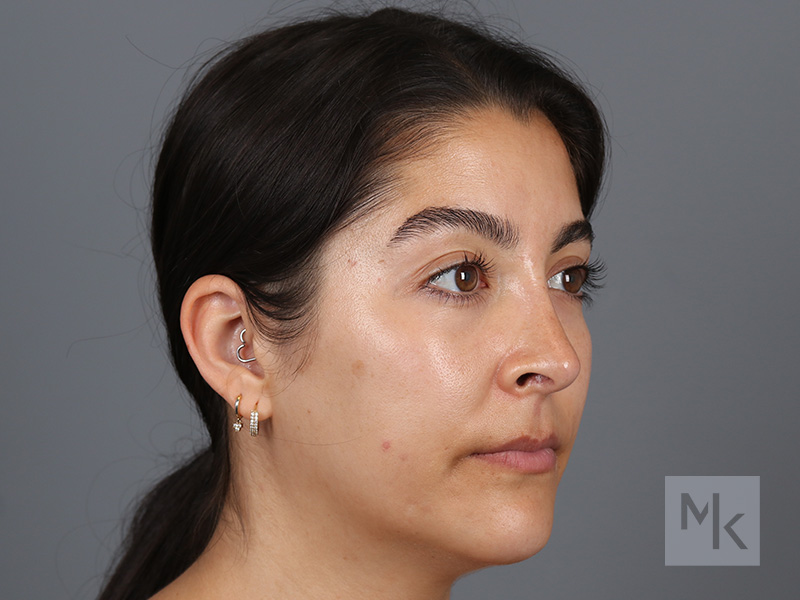 Rhinoplasty Before and After | Dr. Michael Kim