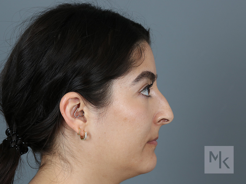 Rhinoplasty Before and After | Dr. Michael Kim