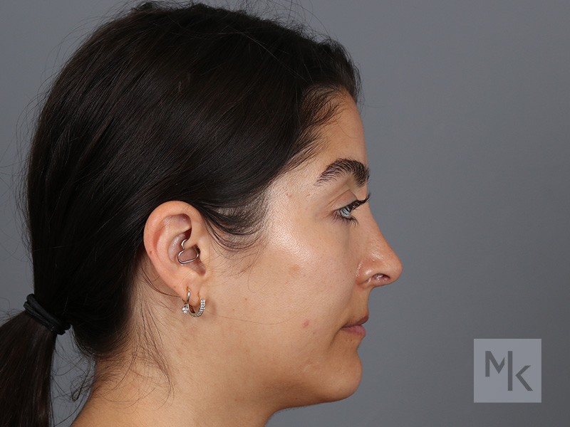 Rhinoplasty Before and After | Dr. Michael Kim