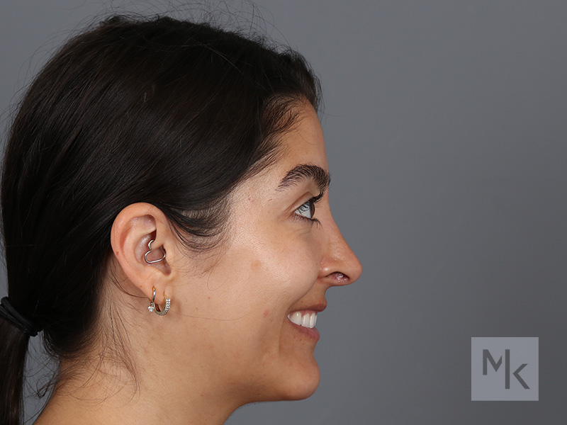 Rhinoplasty Before and After | Dr. Michael Kim