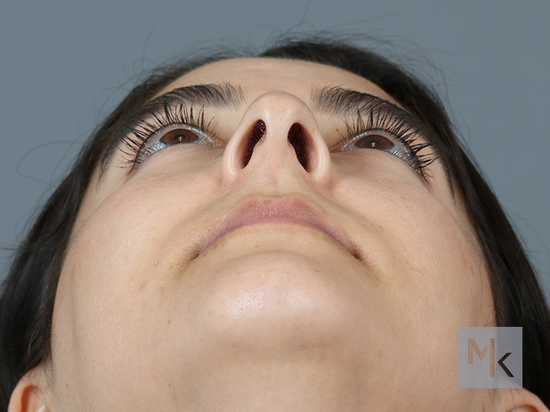 Rhinoplasty Before and After | Dr. Michael Kim