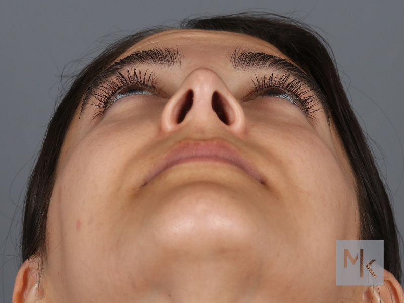 Rhinoplasty Before and After | Dr. Michael Kim