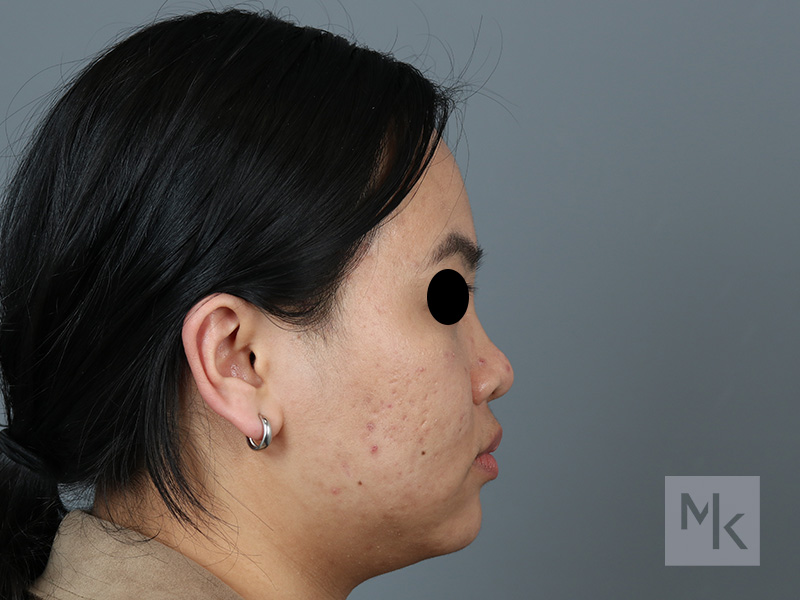 Rhinoplasty Before and After | Dr. Michael Kim