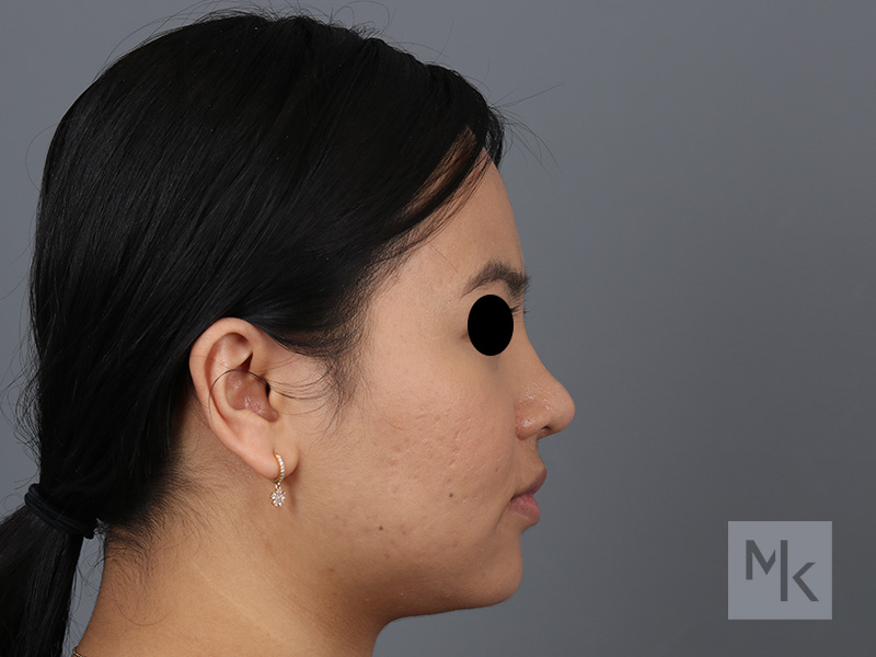 Rhinoplasty Before and After | Dr. Michael Kim