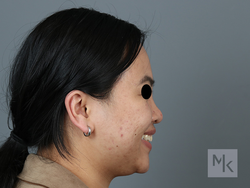 Rhinoplasty Before and After | Dr. Michael Kim