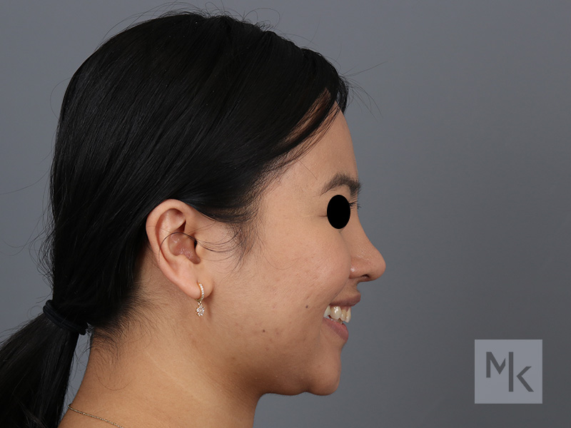 Rhinoplasty Before and After | Dr. Michael Kim