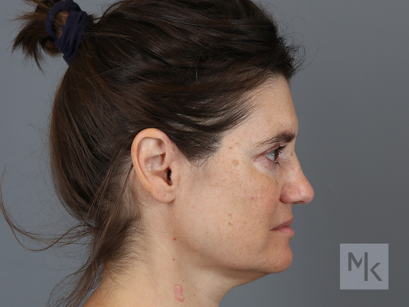 Rhinoplasty Before and After | Dr. Michael Kim