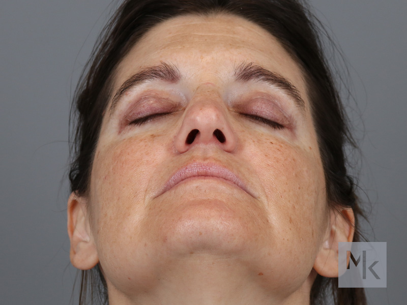 Rhinoplasty Before and After | Dr. Michael Kim